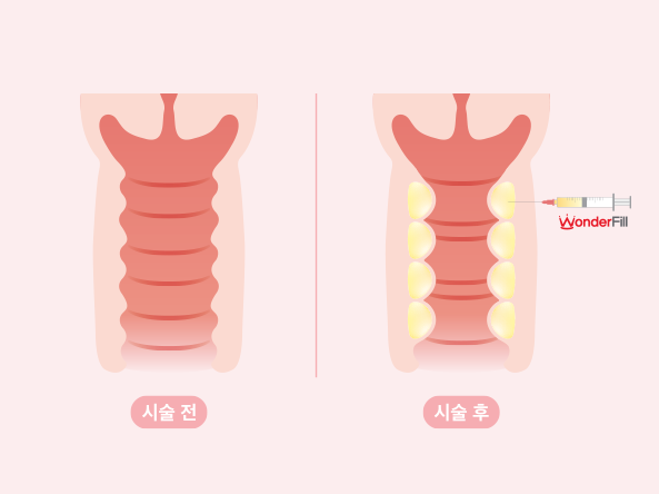 질필러